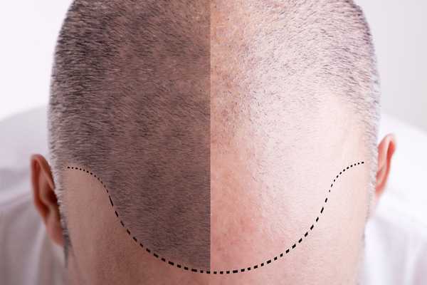 Guide: The Cost of Various Hair Loss Treatments
